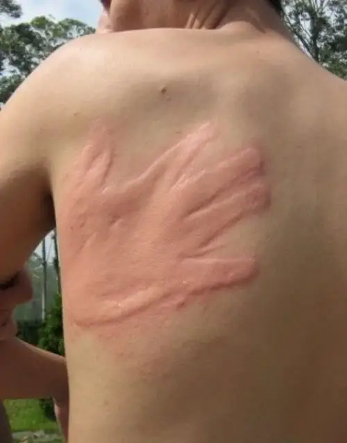 nice-slap-mark.jpg